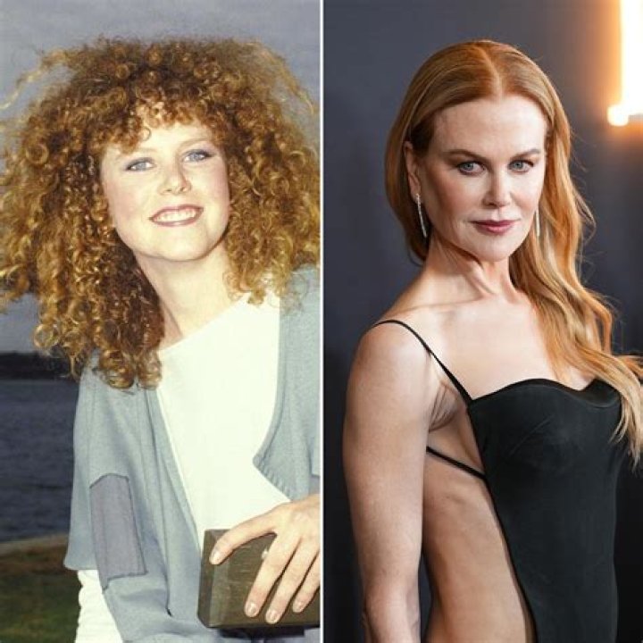 Nicole Kidman: The Unveiling Of Plastic Surgery Secrets